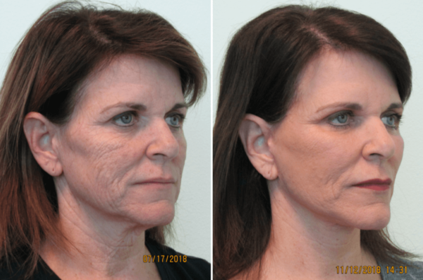 Effective Skin Care Strategy Post Co2 Laser Treatment