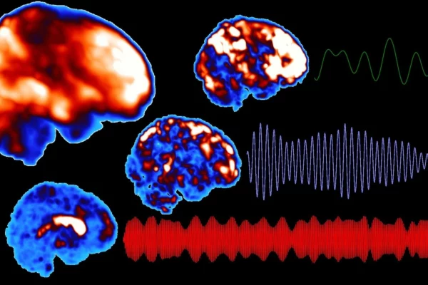 Increase Your Brain’s Focus with Narcolepsy Treatment Increase Your Brain’s Focus with Narcolepsy Treatment