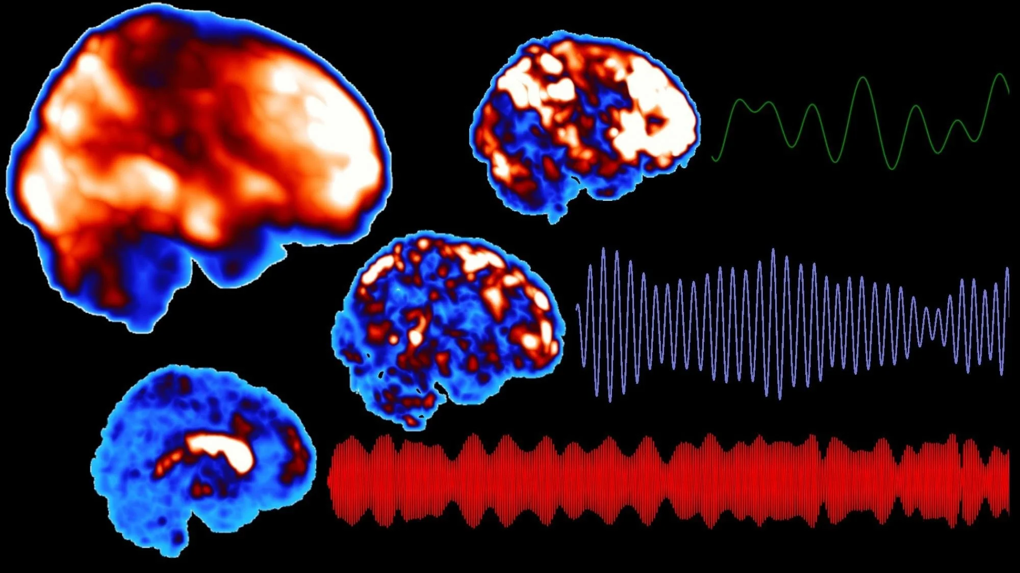 Increase Your Brain’s Focus with Narcolepsy Treatment