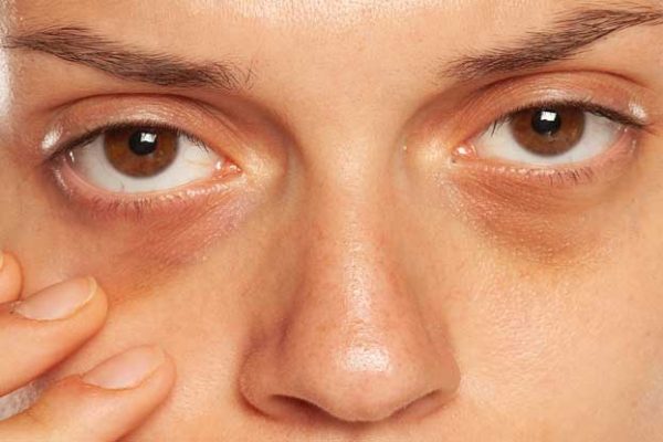 is there a treatment for dark circles under eyes