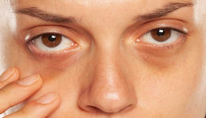 is there a treatment for dark circles under eyes