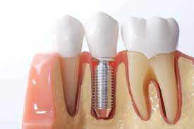 A Guide for Young People Considering Dental Implants A Guide for Young People Considering Dental Implants