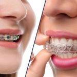 Invisalign vs Braces