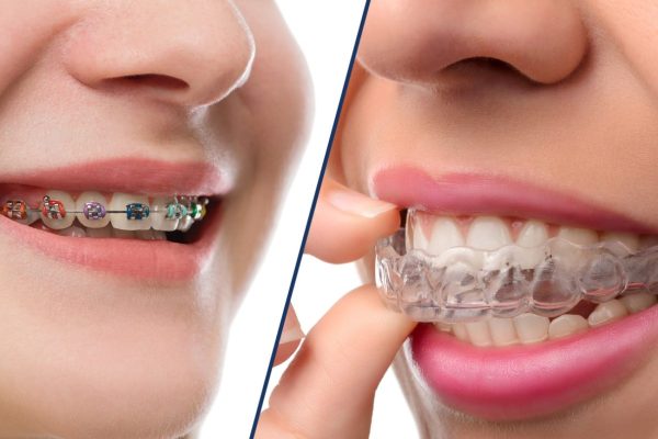 Invisalign vs Braces