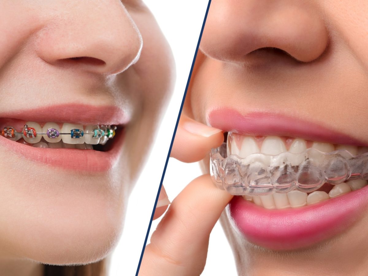 Invisalign vs Braces